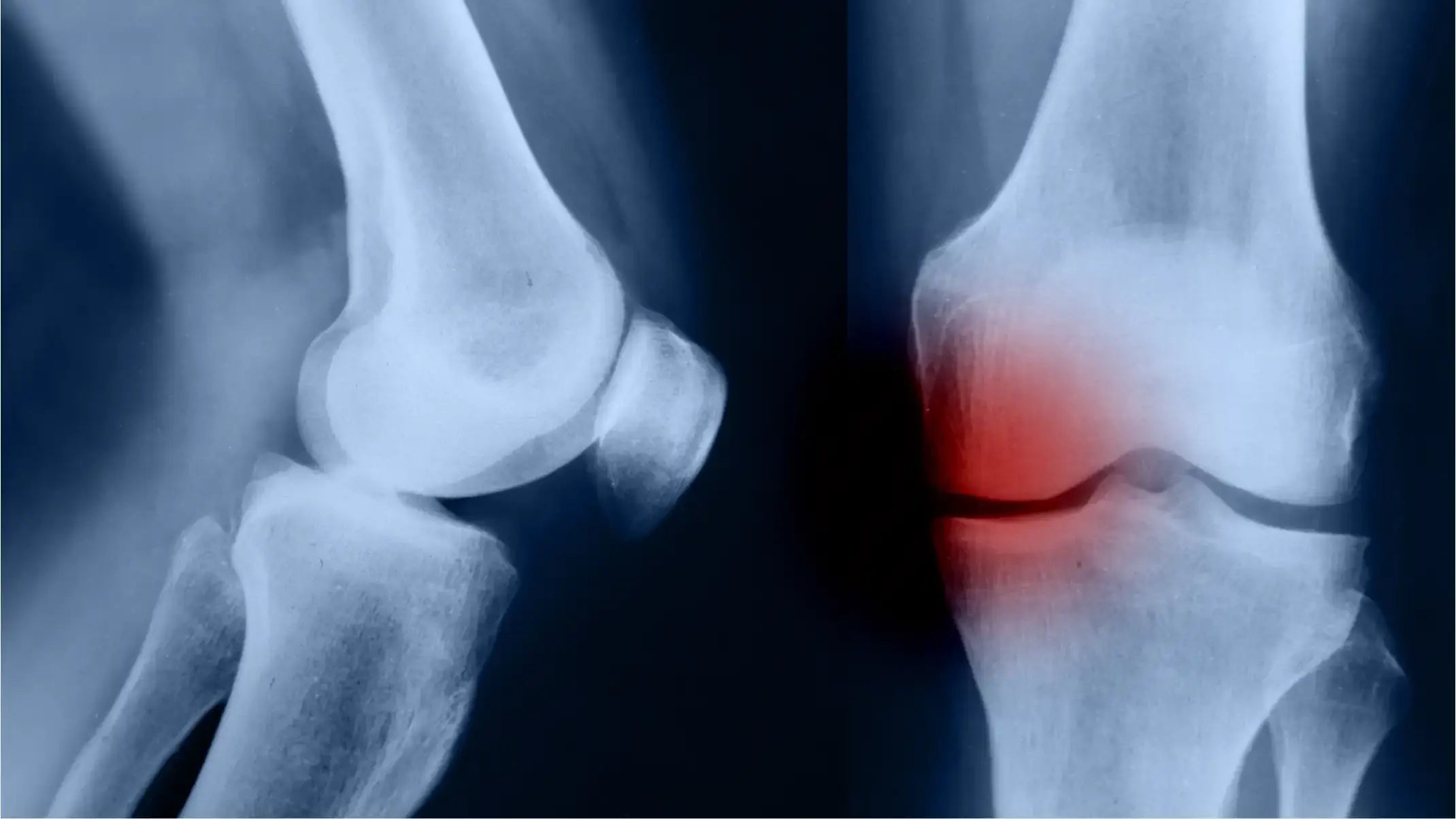 Douleur articulaire : causes, signes et solutions naturelles
